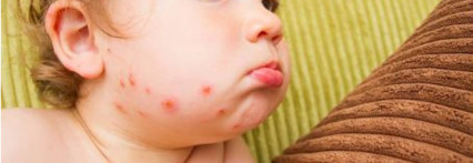 რა არის ჩუტყვავილა?