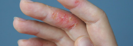 ატოპიური დერმატიტი