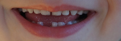 რა ვუყოთ მორყეულ სარძევე კბილებს?