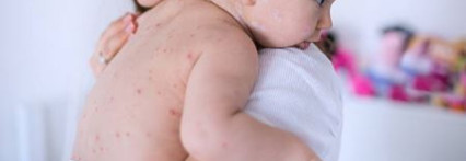 რა არის წითელა