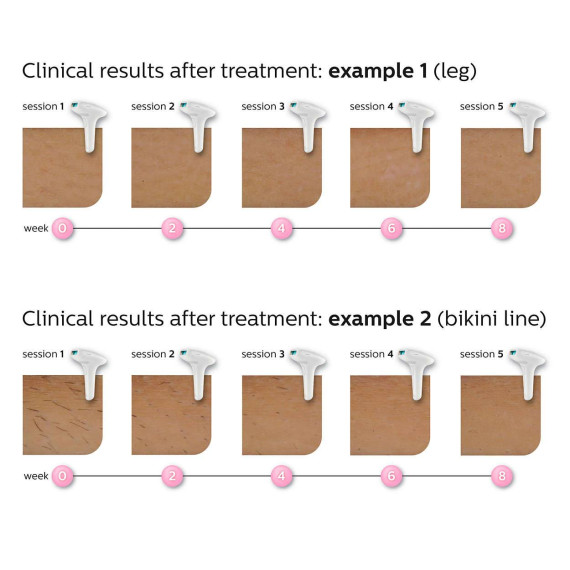 Philips ფოტო ეპილატორი SC1995/00 (ფილიპსი), 6 image